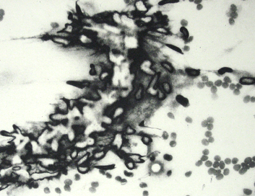 Cancer Cells Part 3